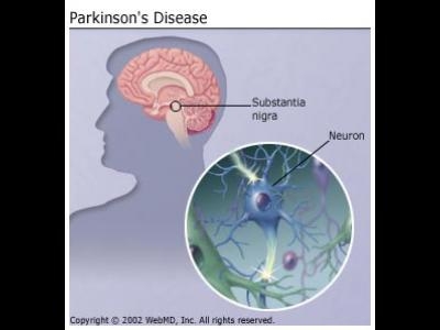 Boala parkinson : Boli si tratamente