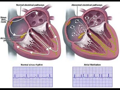Miocarditele cronice : Bolile cardiovasculare